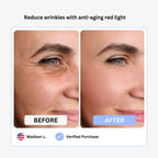 Anti-Wrinkle Beauty Apparatus